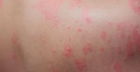 8-Tips-to-handle-Summer-Skin-Problems