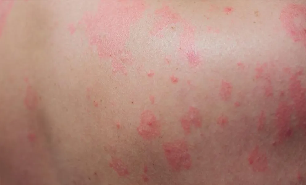 8-Tips-to-handle-Summer-Skin-Problems